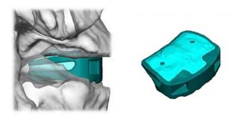 德国首例3D打印钛脊柱成功融合植入手术