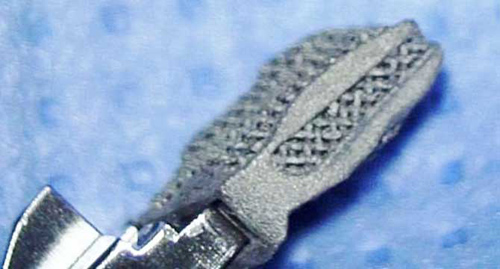 德国首例3D打印钛脊柱成功融合植入手术